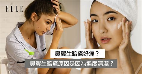 鼻梁生暗瘡|鼻翼暗瘡點算？鼻翼暗瘡原因、鼻翼長痘痘鼻翼生暗瘡。